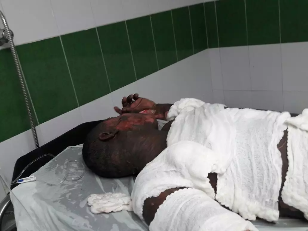 Muere hombre al que le habían pegado fuego con gasolina en la Romana