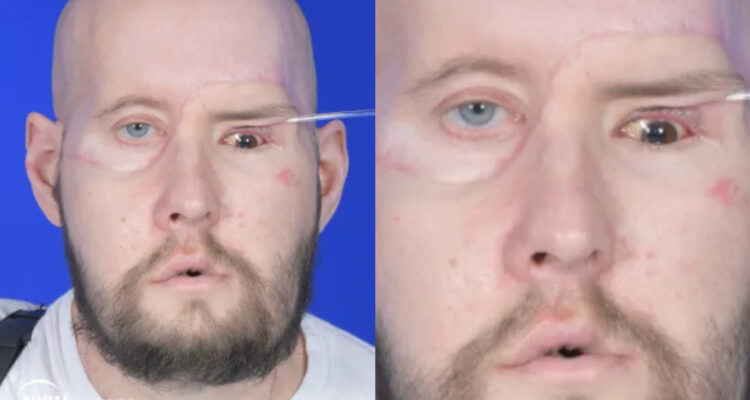 Realizan con éxito primer trasplante de ojo completo en el mundo